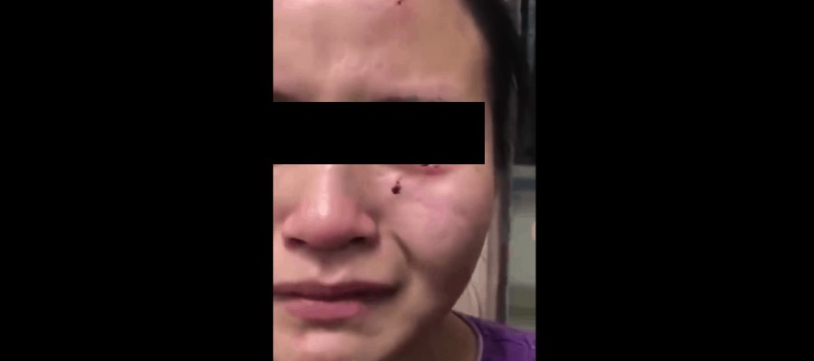 Paciente con Covid-19 golpea y muerde en la cara a enfermera en China Paciente con Covid-19 golpea y muerde en la cara a enfermera en China