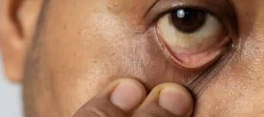Confirman 4 casos de hongo negro en Sinaloa; dos pacientes fallecieron Confirman 4 casos de hongo negro en Sinaloa; dos pacientes fallecieron