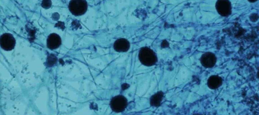 No hay alerta de hongo negro en Tabasco afirma Gobierno