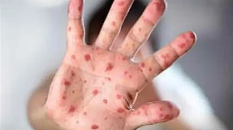 Brote de sarampión suma casi 3 mil casos en México: Salud