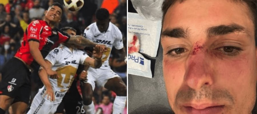 Dinenno es operado tras fractura de nariz contra Atlas Dinenno es operado tras fractura de nariz contra Atlas