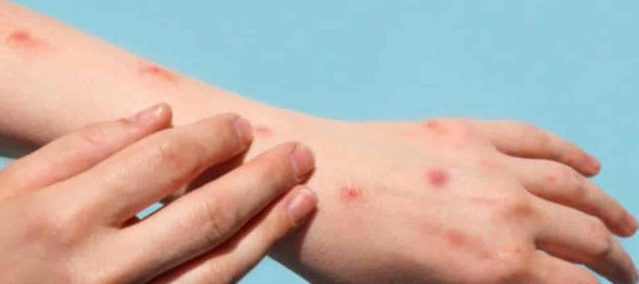 Declara OMS la viruela del mono como emergencia sanitaria de interés internacional