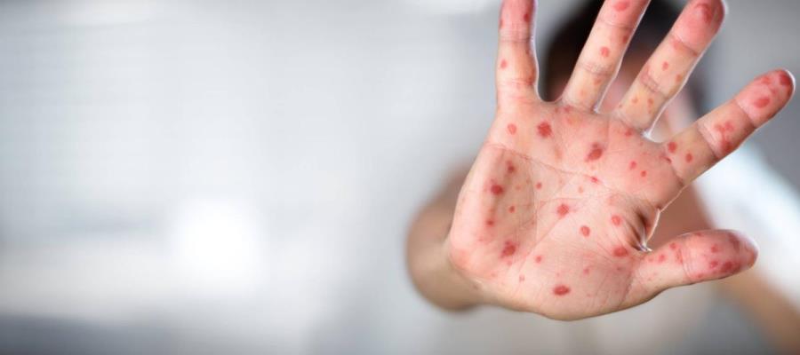 Confirma Salud federal 3 casos de viruela del mono en Tabasco