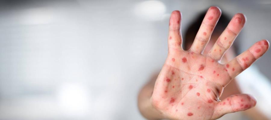 Primer caso de viruela del mono en Tabasco, esto sabemos