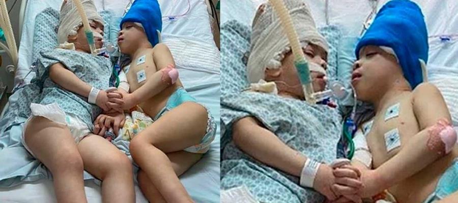 Separan con éxito a siameses unidos por la cabeza en Brasil