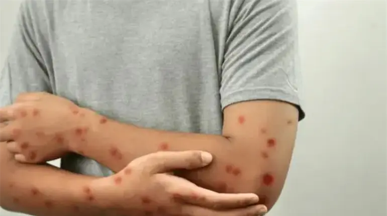 Reportan 6 nuevos casos de viruela símica en Yucatán; activan vigilancia epidemiológica