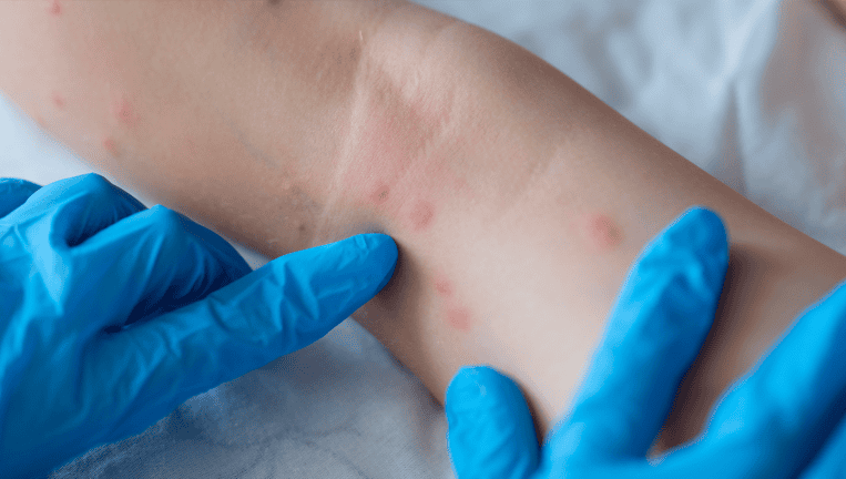 OMS elimina emergencia sanitaria internacional por viruela del mono