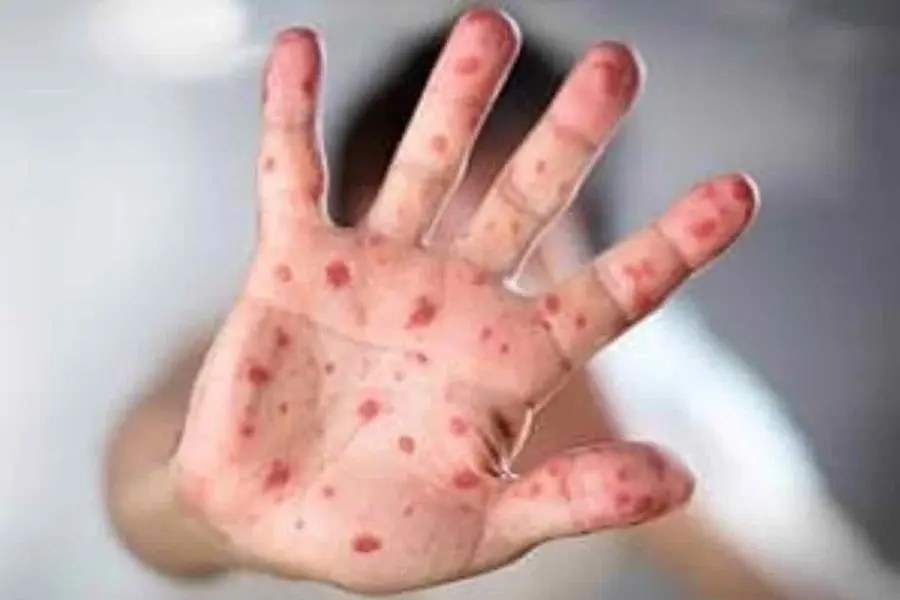 México rebasó los 5 mil casos de sarampión: Salud