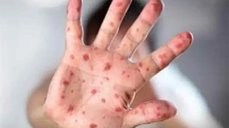 México rebasó los 5 mil casos de sarampión: Salud