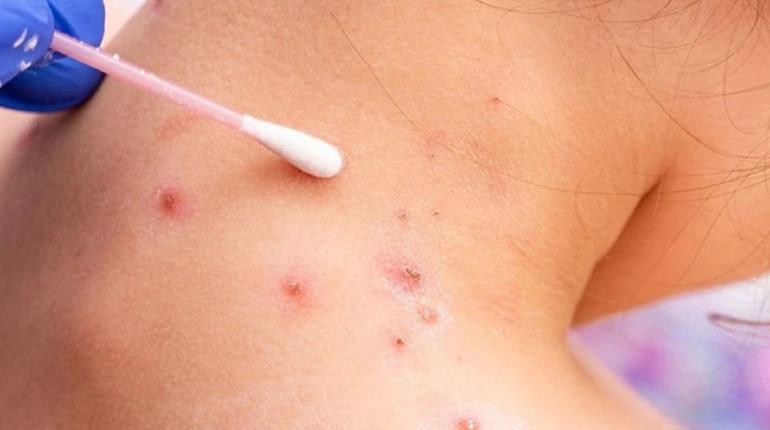Tabasco, sin ningún caso sospechoso de viruela del mono: IMSS Bienestar