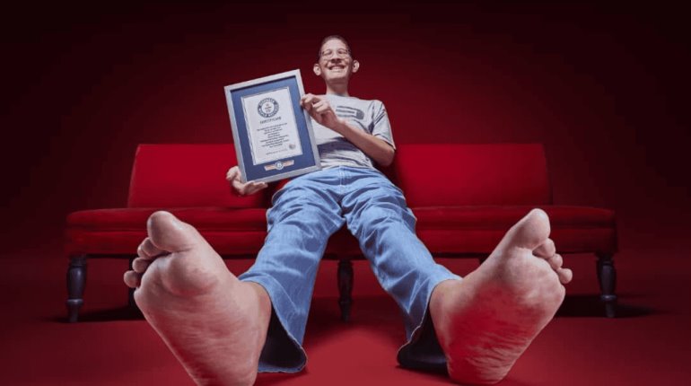 Jeison, el hombre que vive con acrogigantismo y tiene los pies más grandes del mundo