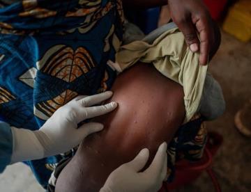 OMS autoriza primera vacuna contra Mpox en África