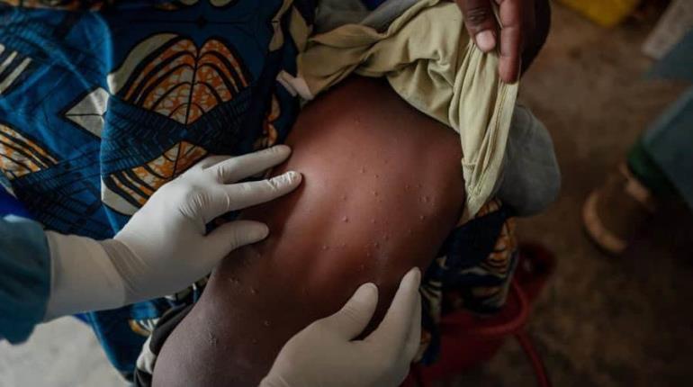 OMS autoriza primera vacuna contra Mpox en África