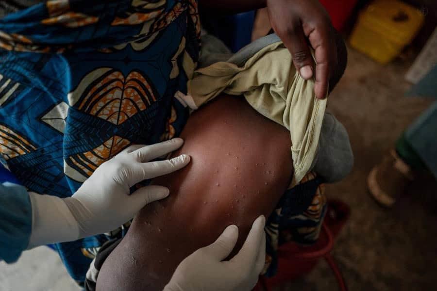 OMS autoriza primera vacuna contra Mpox en África