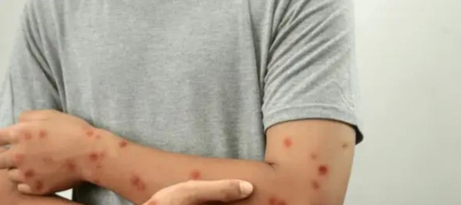 Reportan 6 nuevos casos de viruela símica en Yucatán; activan vigilancia epidemiológica Reportan 6 nuevos casos de viruela símica en Yucatán; activan vigilancia epidemiológica