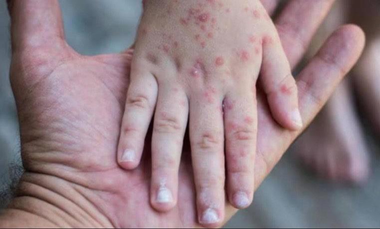 Emite Salud Federal aviso preventivo para quien viaje a Texas por brote de sarampión