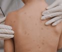Instalan cerco sanitario por casos de varicela en Tabasco