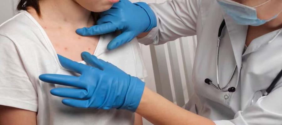 Confirman primer caso de sarampión en Tabasco Confirman primer caso de sarampión en Tabasco