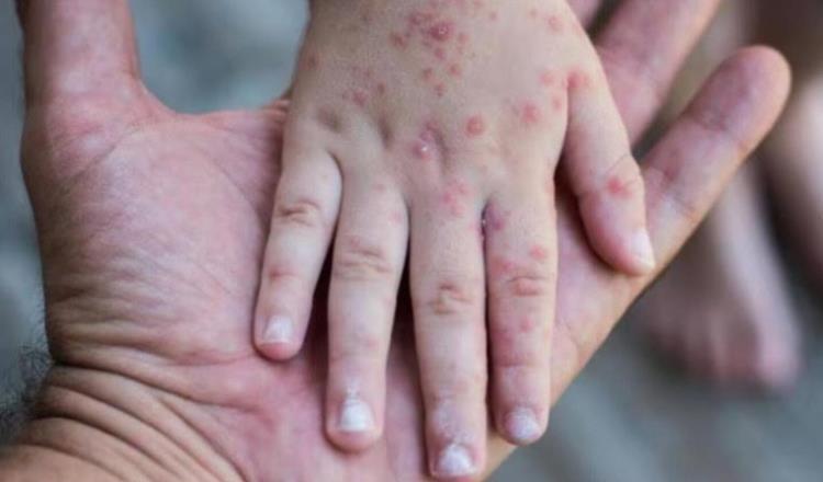 Guanajuato registra su primer caso de sarampión tras 30 años sin contagios Guanajuato registra su primer caso de sarampión tras 30 años sin contagios