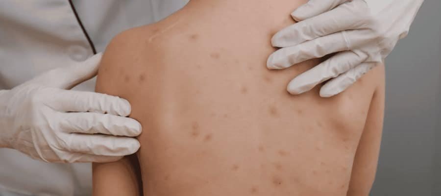 Se disparan casos de varicela en Tabasco; van 919 en el año Se disparan casos de varicela en Tabasco; van 919 en el año