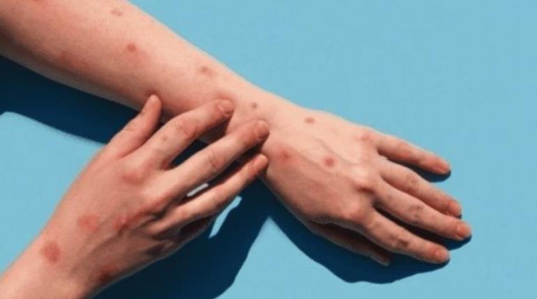 Mantiene OMS la alerta por mpox o viruela del mono