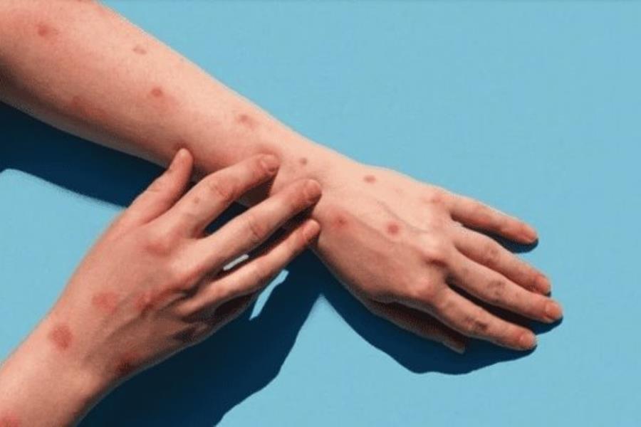 Mantiene OMS la alerta por mpox o viruela del mono Mantiene OMS la alerta por mpox o viruela del mono