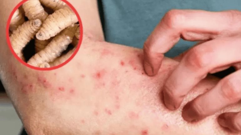 Van 13 casos de miasis en humanos por gusano barrenador hasta la última semana de mayo: Salud