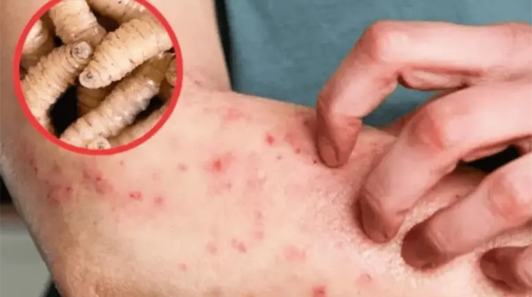 Van 13 casos de miasis en humanos por gusano barrenador hasta la última semana de mayo: Salud