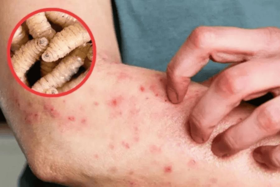 Van 13 casos de miasis en humanos por gusano barrenador hasta la última semana de mayo: Salud Van 13 casos de miasis en humanos por gusano barrenador hasta la última semana de mayo: Salud