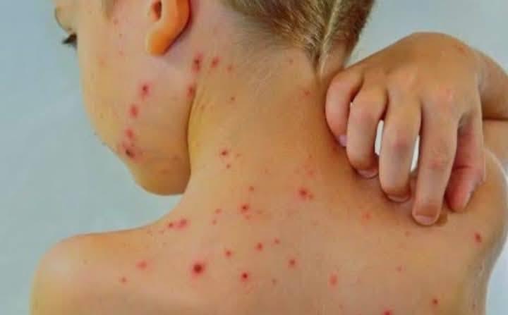 Descarta Salud brote de sarampión en Tabasco; llama a aprovechar vacunas Descarta Salud brote de sarampión en Tabasco; llama a aprovechar vacunas