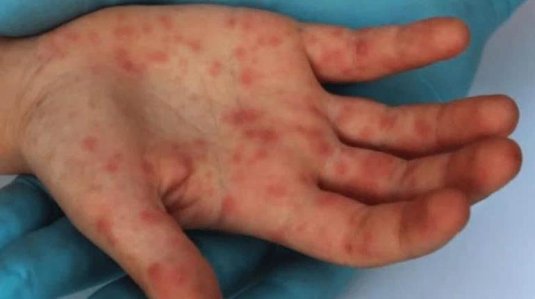 Muere paciente con Viruela Símica en Cancún