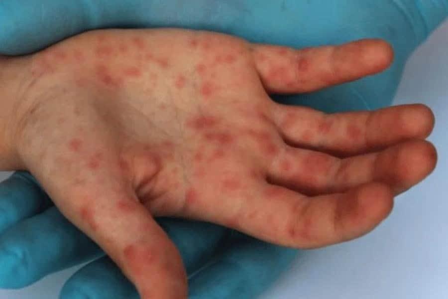 Muere paciente con Viruela Símica en Cancún Muere paciente con Viruela Símica en Cancún