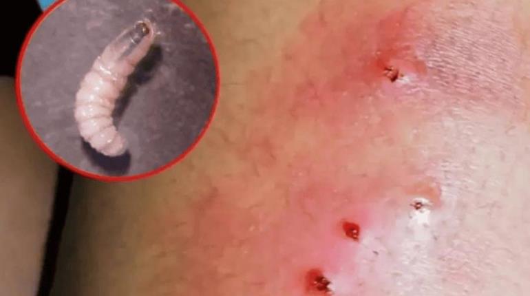 31 casos de miasis por gusano barrenador en humanos, reporta Salud