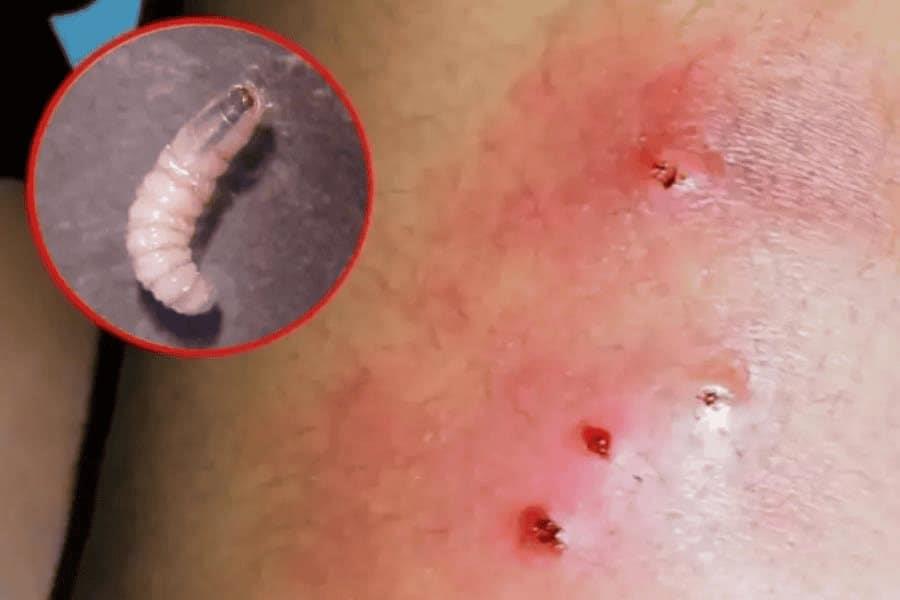 31 casos de miasis por gusano barrenador en humanos, reporta Salud