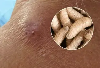 En Tabasco se han registrado 2 casos de gusano barrenador en humanos, pero ya están curados: Salud