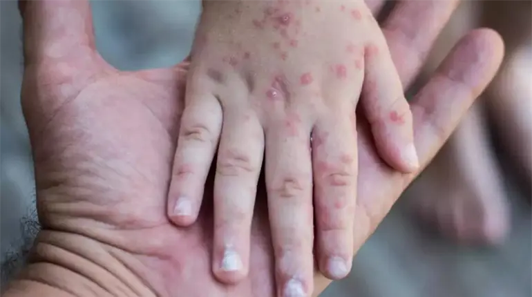 Confirma SSA 23 casos del virus Coxsackie en Calkiní, Campeche