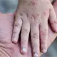 Confirma SSA 23 casos del virus Coxsackie en Calkiní, Campeche