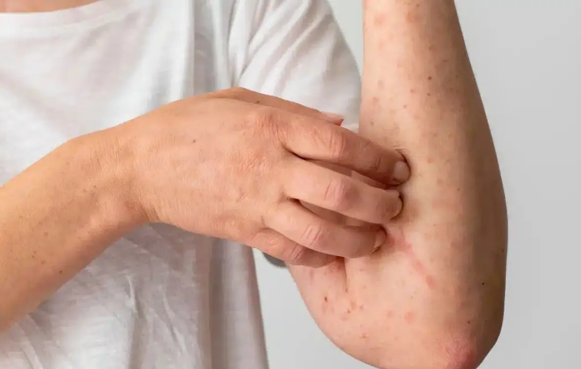 Informa Morelos, 13 casos importados de sarampión; ya suman 5 mil en todo el país