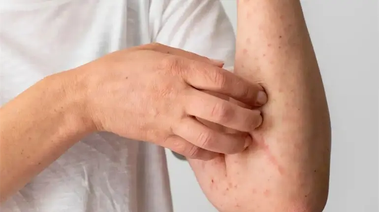 Informa Morelos, 13 casos importados de sarampión; ya suman 5 mil en todo el país