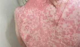 Implementar protocolos para proteger a la poblaci&oacute;n del sarampi&oacute;n, pide diputada perredista