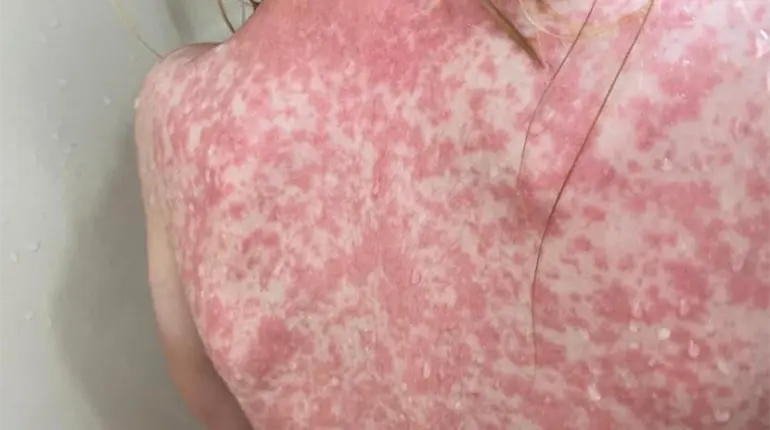 Implementar protocolos para proteger a la poblaci&oacute;n del sarampi&oacute;n, pide diputada perredista