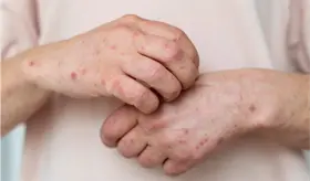 Sigue imparable el sarampi&oacute;n, M&eacute;xico registra casi 6 mil casos