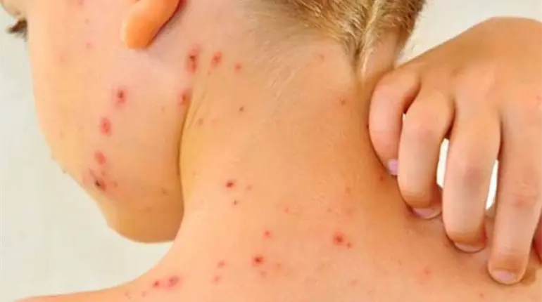 Tabasco acumula 12 casos de sarampi&oacute;n