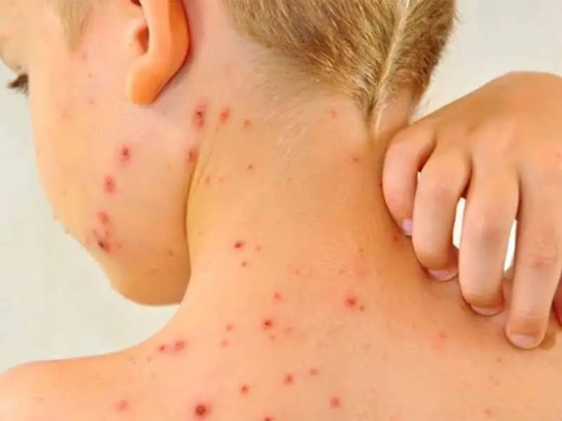 Tabasco acumula 12 casos de sarampión