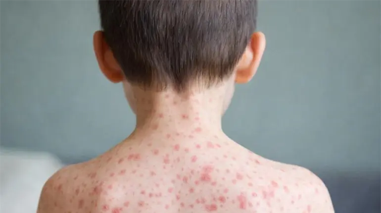 Tabasco en b&uacute;squeda activa de casos de sarampi&oacute;n